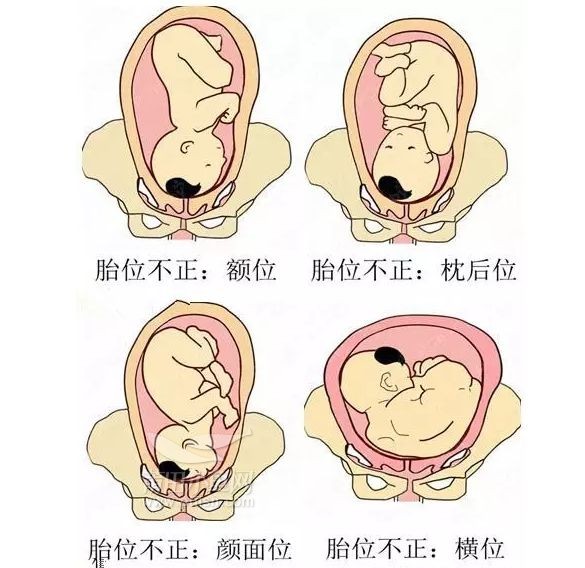 胎位不正臀位的纠正方法是什么?